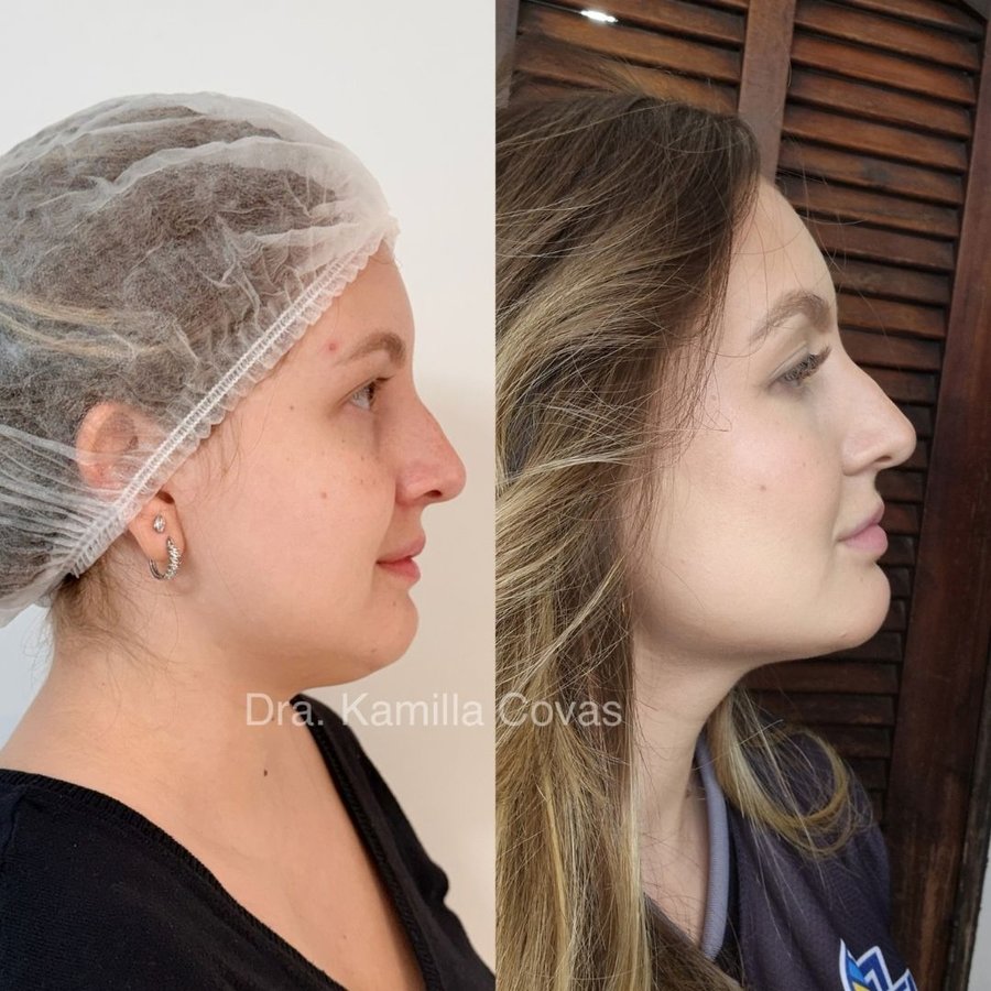 Antes e depois da lipo de papada realizada na Ayo Clinic (1/3)