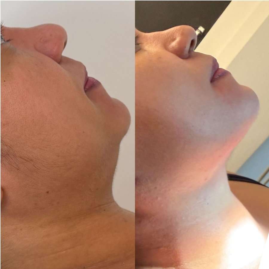 Antes e depois da lipo de papada realizada na Ayo Clinic (2/3)