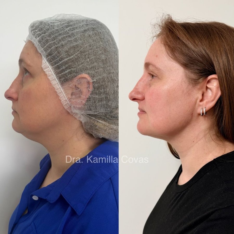 Antes e depois da lipo de papada realizada na Ayo Clinic (3/3)