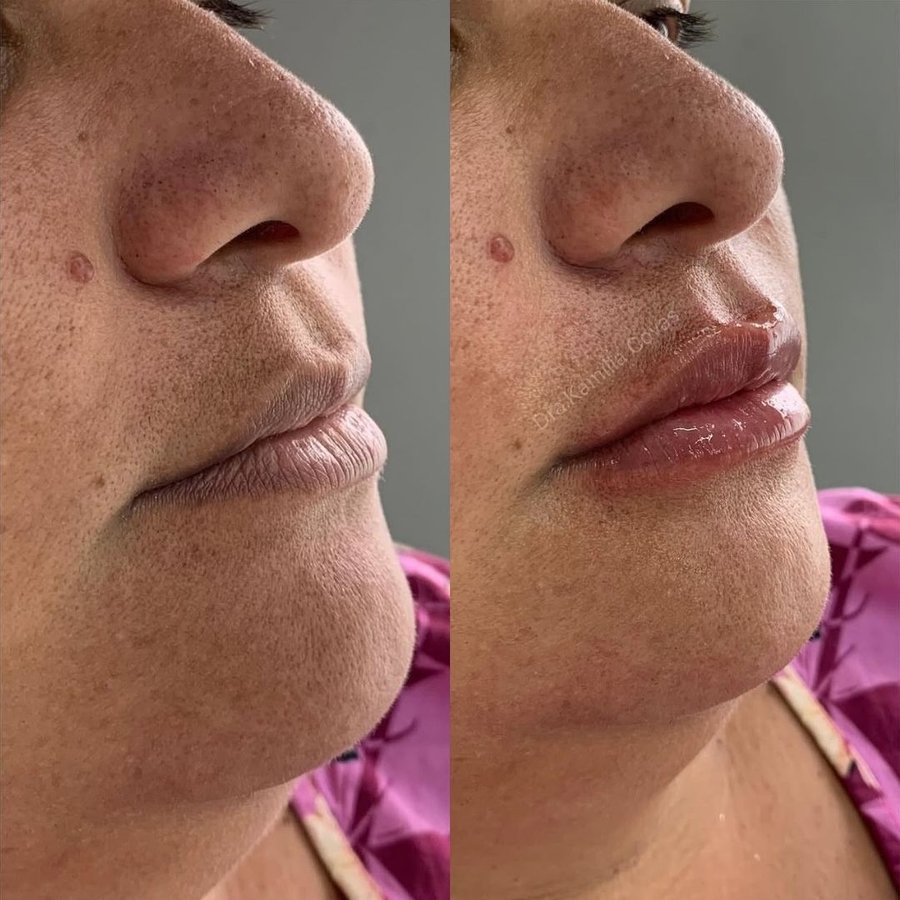 Antes e depois do preenchimento labial realizado na Ayo Clinic (1/3)