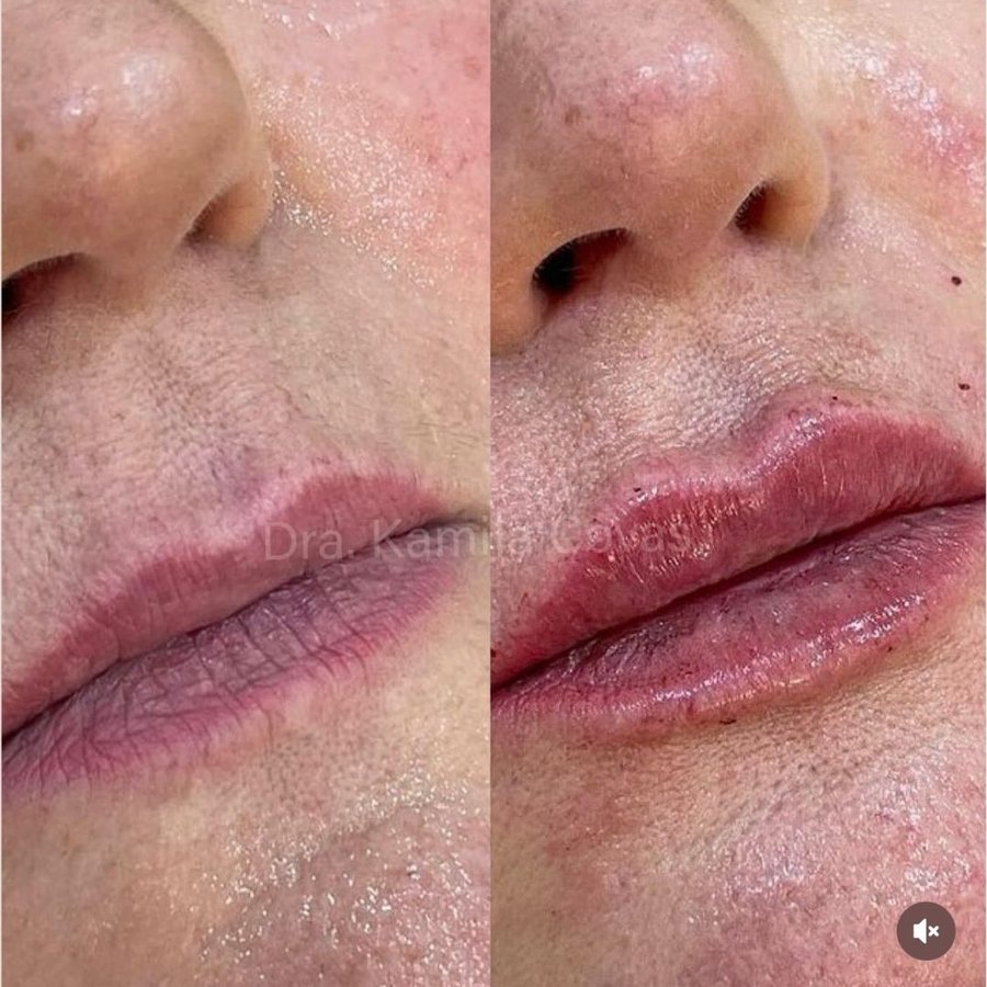 Antes e depois do preenchimento labial realizado na Ayo Clinic (2/3)