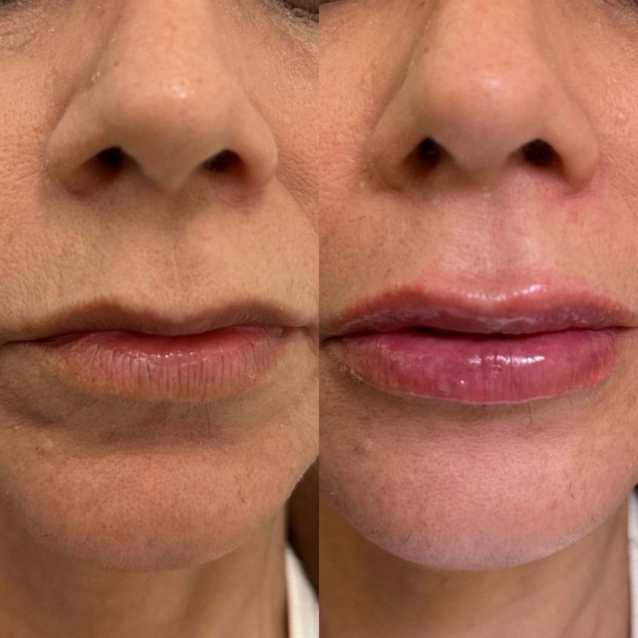 Antes e depois do preenchimento labial realizado na Ayo Clinic (3/3)